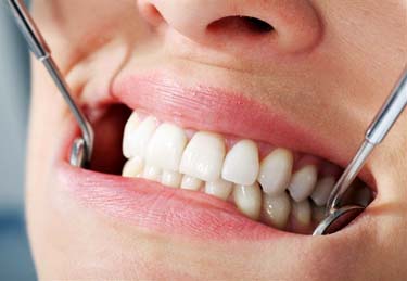 зубные импланты - подарите себе яркую улыбку